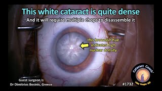 CataractCoach™1732: this white cataract is quite dense