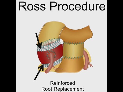 Mayo Clinic – Ross Procedure