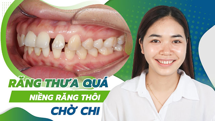 Bọc sứ răng thưa bao nhiêu tiền năm 2024