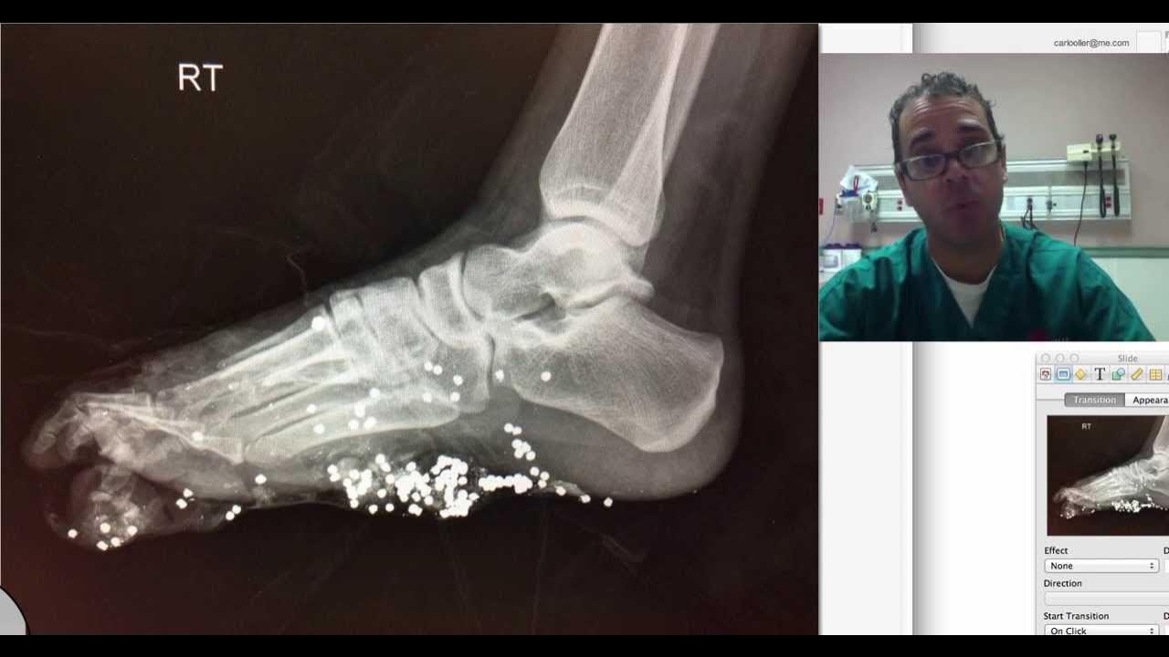 foot xray potpourri YouTube