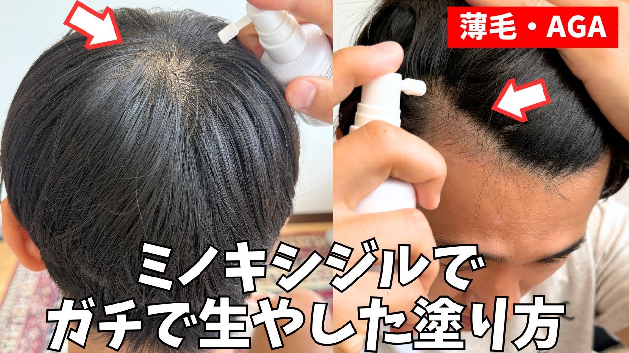 ５年薄毛治療してわかった効果的なミノキシジルの塗り方とは？塗りミノの使い方まとめ【薄毛・AGA治療】