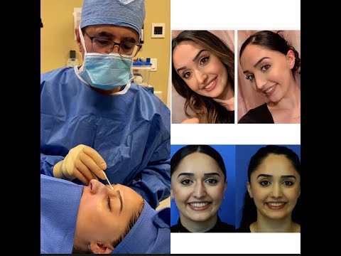 Video thumbnail: Dr. Sajjadian corrected everything that I didn't like about my nose! Rhinoplasty before and after! · Ali Sajjadian