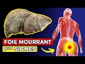 Foie mourrant  12 symptmes tranges que le foie est malade 