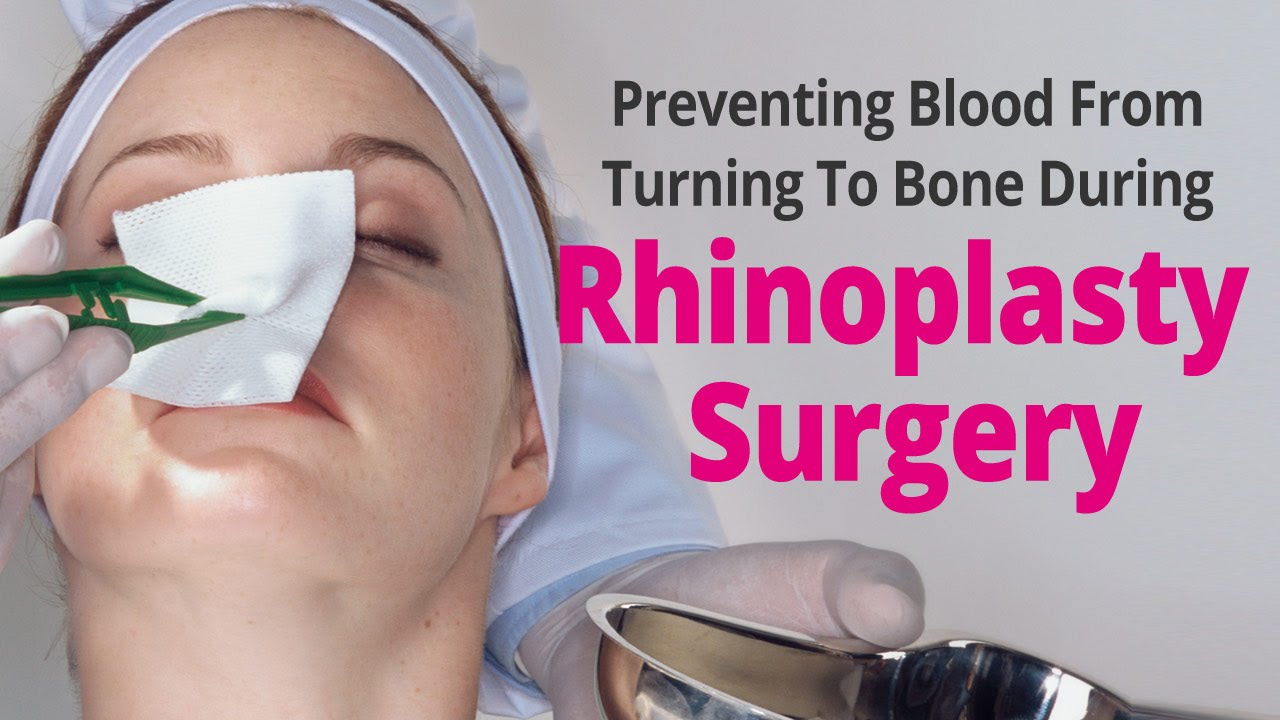 Preventing Blood From Turning To Bone During Rhinoplasty Surgery YouTube