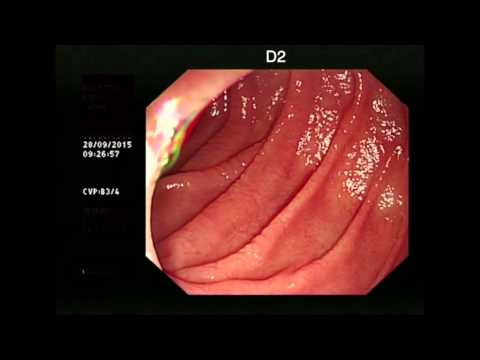 Coeliac Disease - typical endoscopic appearance - YouTube