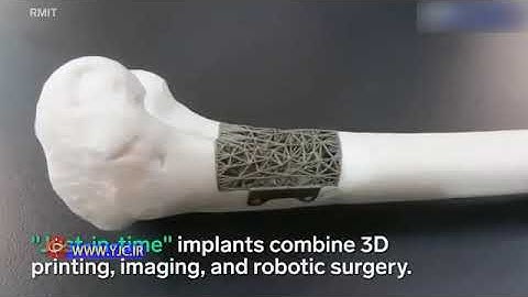 3D printing, Bone, Scaffold, SLS, FDM, Bone sarcoma