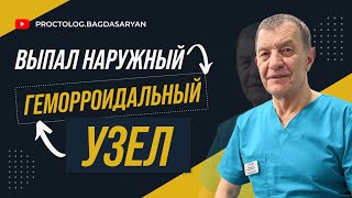 Выпал наружный ГЕМОРРОИДАЛЬНЫЙ УЗЕЛ