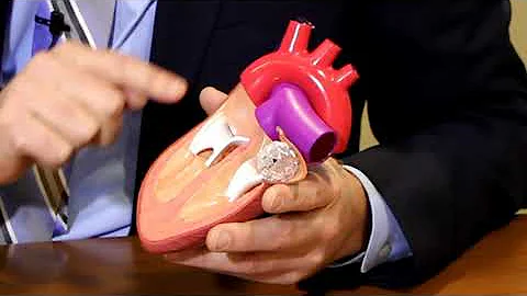 Watchman Device, preventing strokes in patients wi...