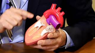 Watchman Device, preventing strokes in patients with Atrial Fibrillation, Lee MacDonald, MD.