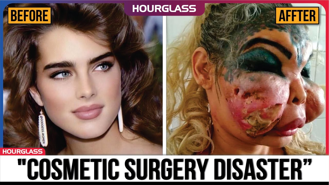 Famous Celebrities Unrecognizable After Plastic Surgery Gone Wrong