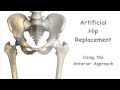 Artificial Hip Replacement - Anterior Approach