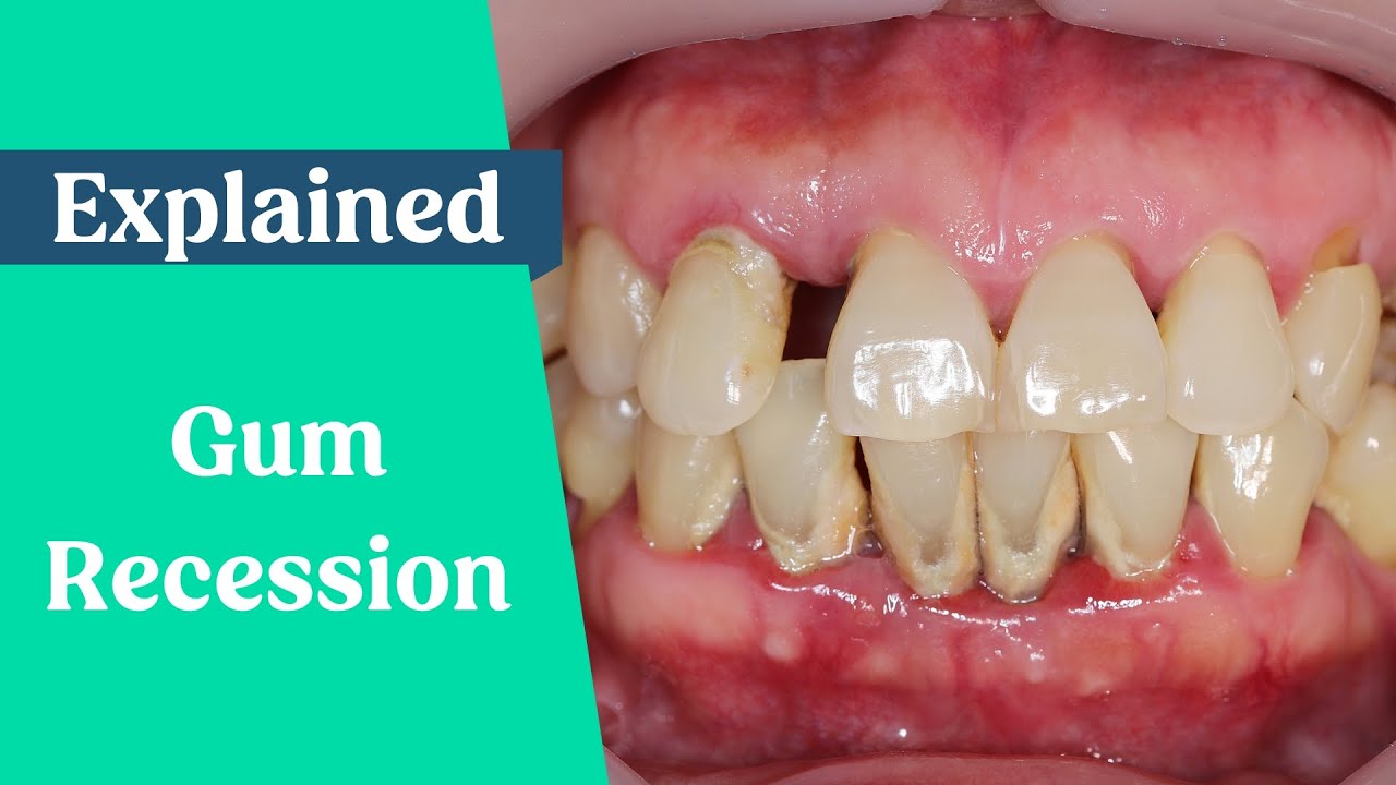 What Causes Gum Recession How To Stop Receding Gums YouTube