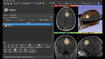 Brain tumor segmentation on MRI in 1 minute