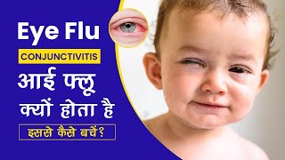 Eye Flu : Conjunctivitis यानी आई फ्लू क्यों होता है, इससे कैसे बचें How to Prevent Conjunctivitis