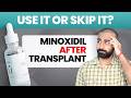 Minoxidil After Hair Transplant | When to start Minoxidil after Hair Transplant Surgery| URoots #qht