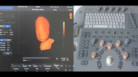 CHISON i3 4D Training Video