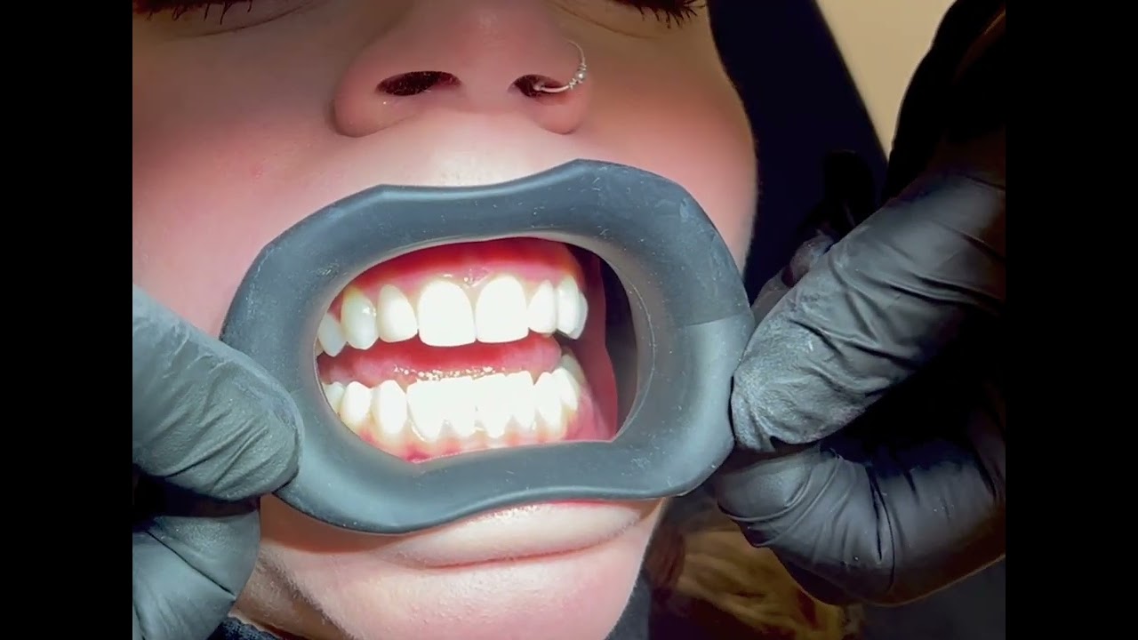 VisionButler - The re-usable, autoclavable lip and cheek retractor / photo-contraster.