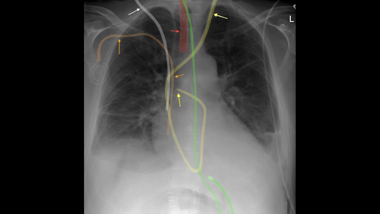 chest tube x ray