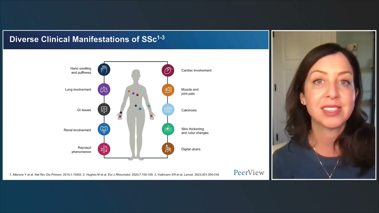 Frameworks for Identifying Systemic Sclerosis and Its Complications