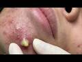 Feel The Extraction Through The Screen | Pimple Popping #800126