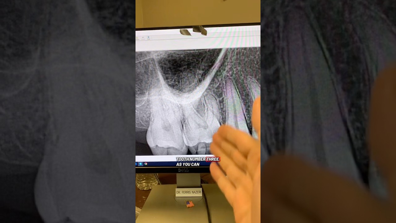 3 корневых канала. 