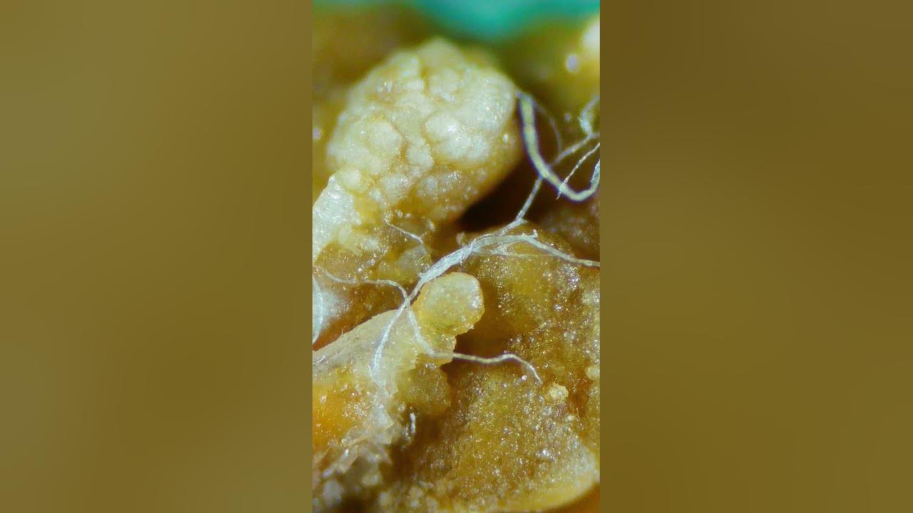 5-mm-kidney-stone-zoomed-in-view-kidneystone-digitalmicroscope-youtube