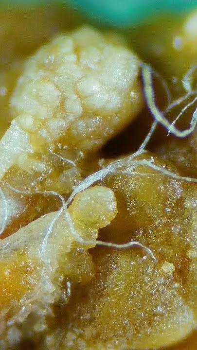 5-mm-kidney-stone-zoomed-in-view-kidneystone-digitalmicroscope-youtube