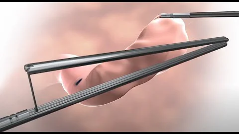 Animation of Sleeve Gastrectomy with Standard Clamp®