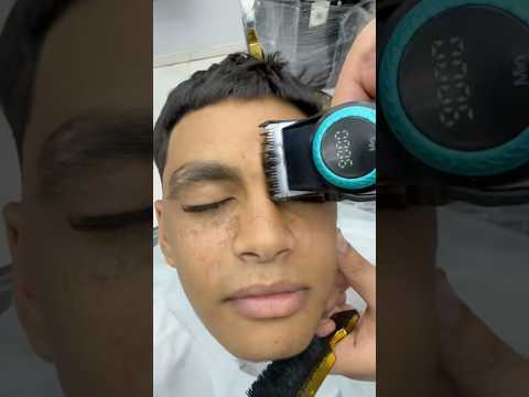 ازالة الحباية المتسلطنة من الدماغ       