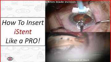 iStent Placement Video - Avoid Complications w/ Trabecular Micro Bypass MIGS