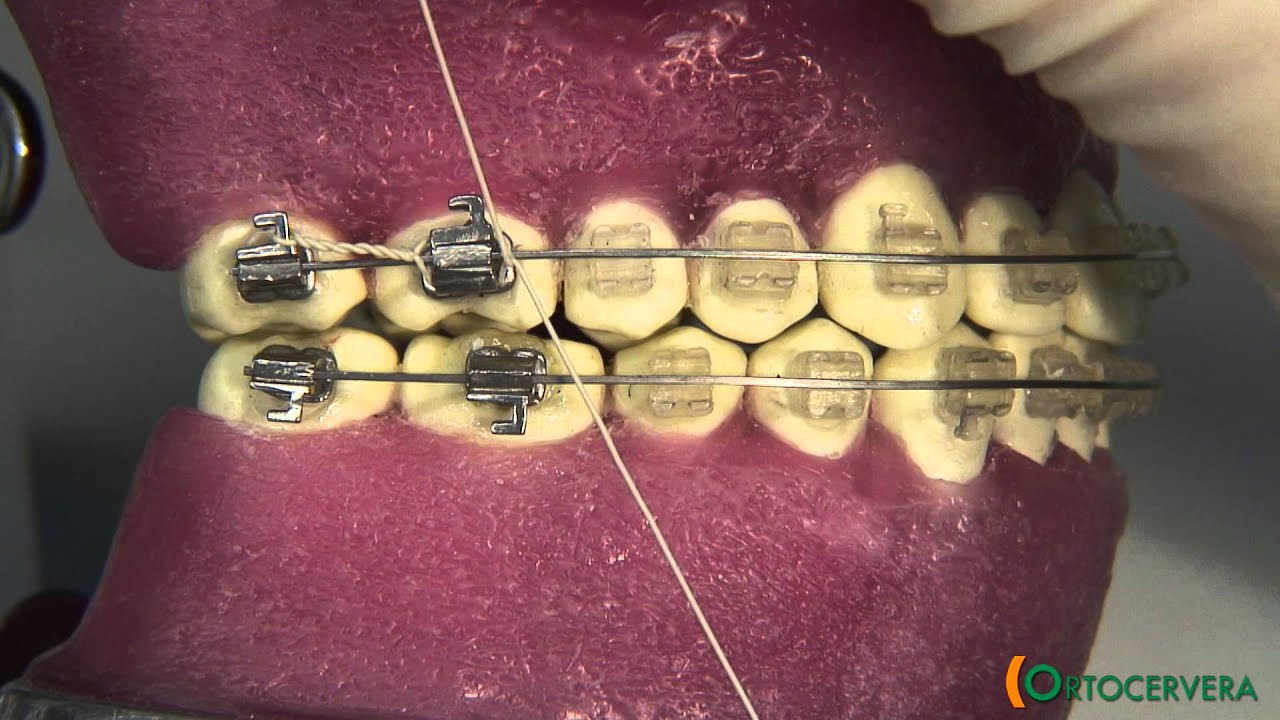 ORTOCERVERA / Ortodoncia: Ligadura Continua Trenzada