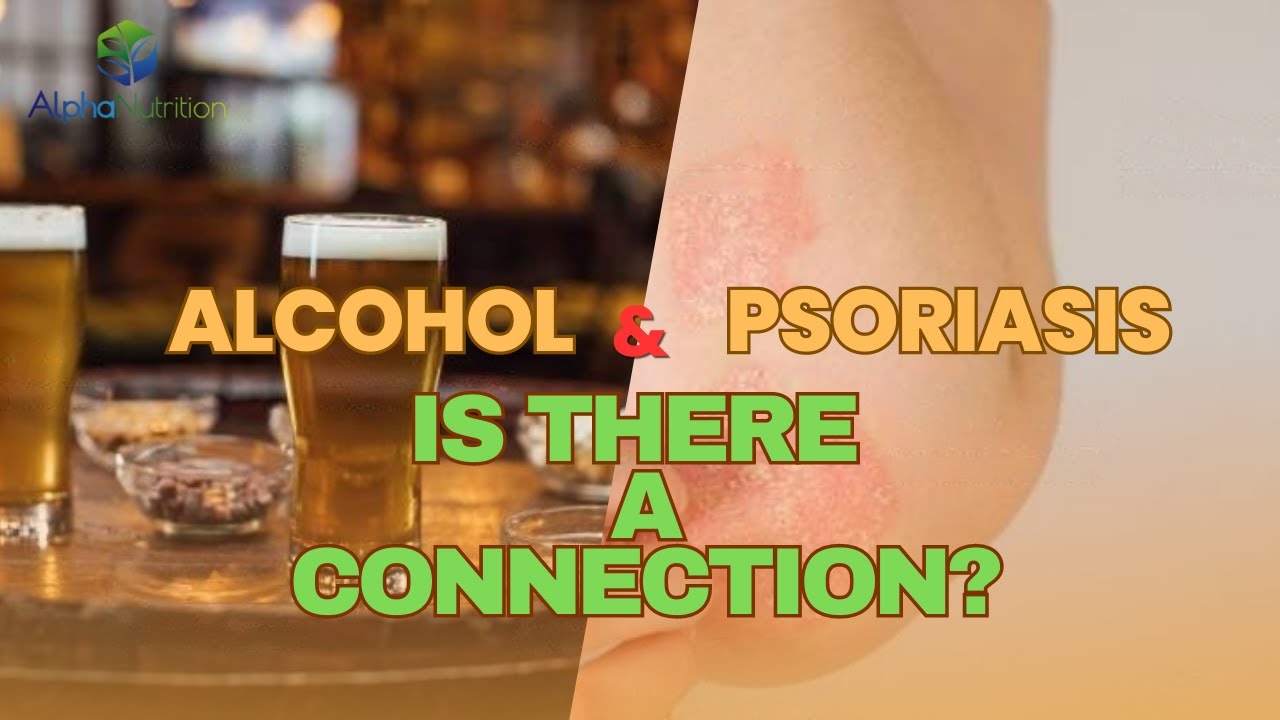 Alcohol & Psoriasis Is There a Connection? YouTube