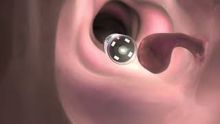 Colon cancer screening | PillCam Colon | Medtronic screenshot 5