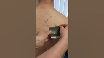 PCDS how to take fungal scrapes