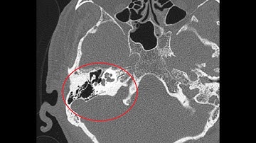 HRCT Temporal bone | A more detailed version | Basic to Advanced : AXIAL & CORONAL         VERSION 2