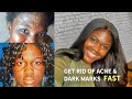 GET RID OF ACNE AND FADE DARK MARKS | ACNE.ORG | I CHANGED MY LIFE WITH $60 DOLLARS