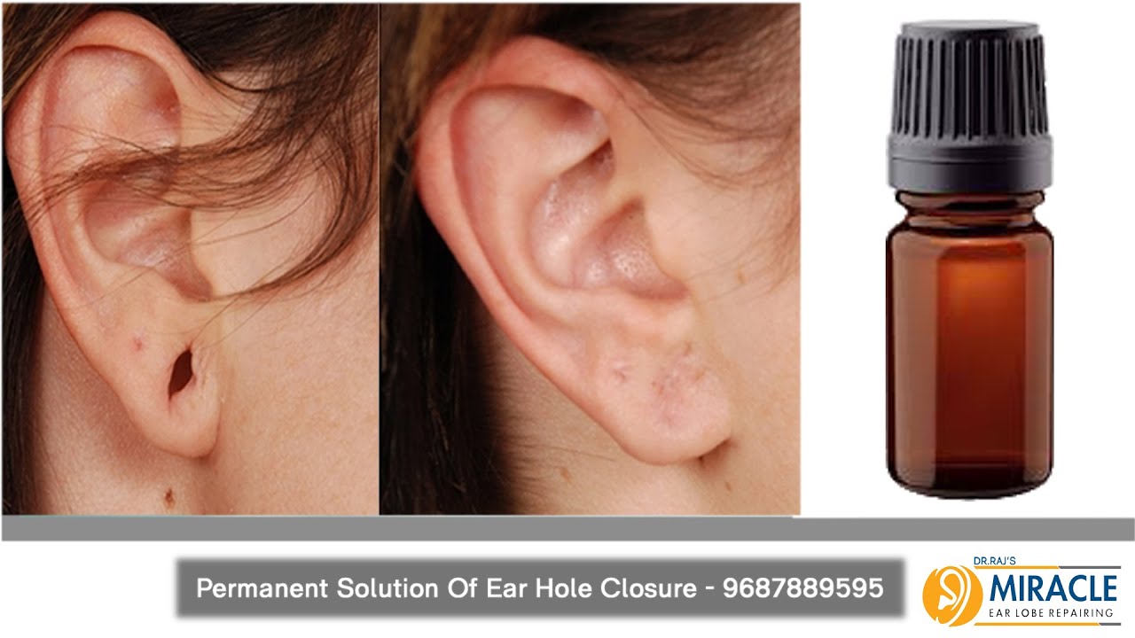 Earlobe Repair - Dr.Amit Kerure Skin Clinic