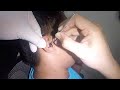 Mans huge hard earwax removed from his ear