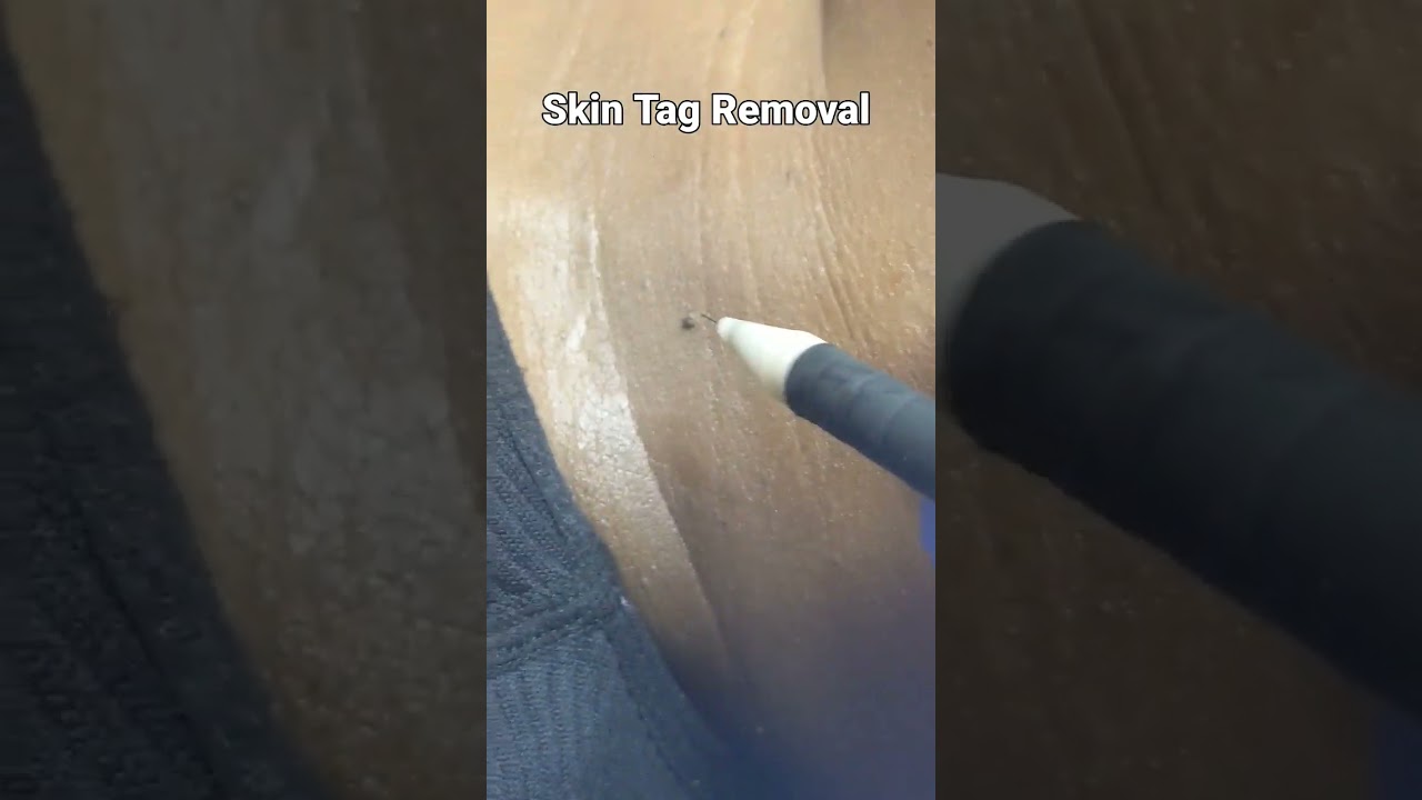 Skin Tag Removal On Her Neck using the Skin Classic Electro Cauterization machine.