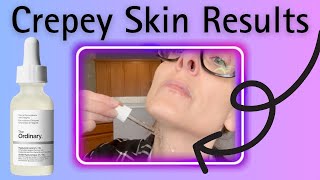 The Ordinary Hyaluronic Acid 2% + B5 Review | Crepey Skin Hydration Results