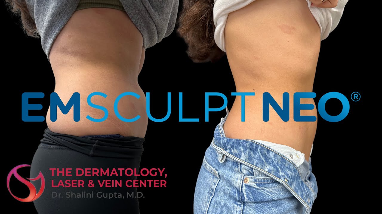 Does Emsculpt Neo Actually Work? Watch for Before and After