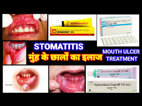 ቪዲዮ: Stomatitis በልጅ ላይ እንዴት ይገለጻል?