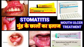 Stomatitis | मुंह के छाले का इलाज | Mouth Ulcer Treatment | Stomatitis In Hindi| Muh K Chale Ka Ilaj