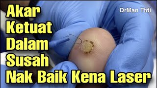 LASER KETUAT TAPAK KAKI  - @DrManTtdi