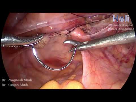 TLH + High uterosacral suspension by Dr pragnesh shah,motera,Heli womens hospital