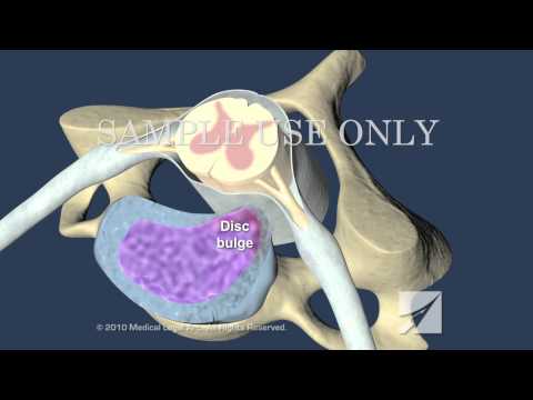 Cervical Disc Herniation