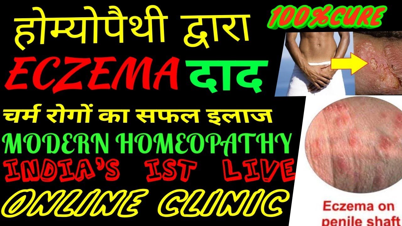 Eczema ringworm dermatitis in penis testes groin region live clinic