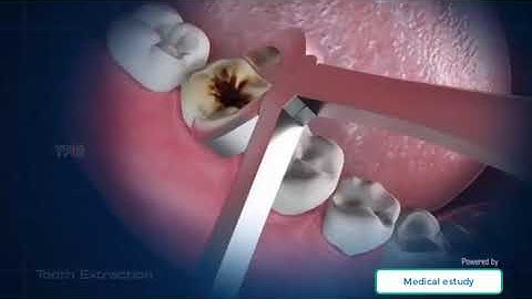 Animation video | Tooth Extraction Procedure
