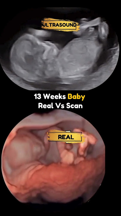 13 Weeks Baby Playing 😍 Real Fetoscopy Vs Ultrasound Video