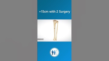 How is limb lengthening surgery performed with Precice 2?